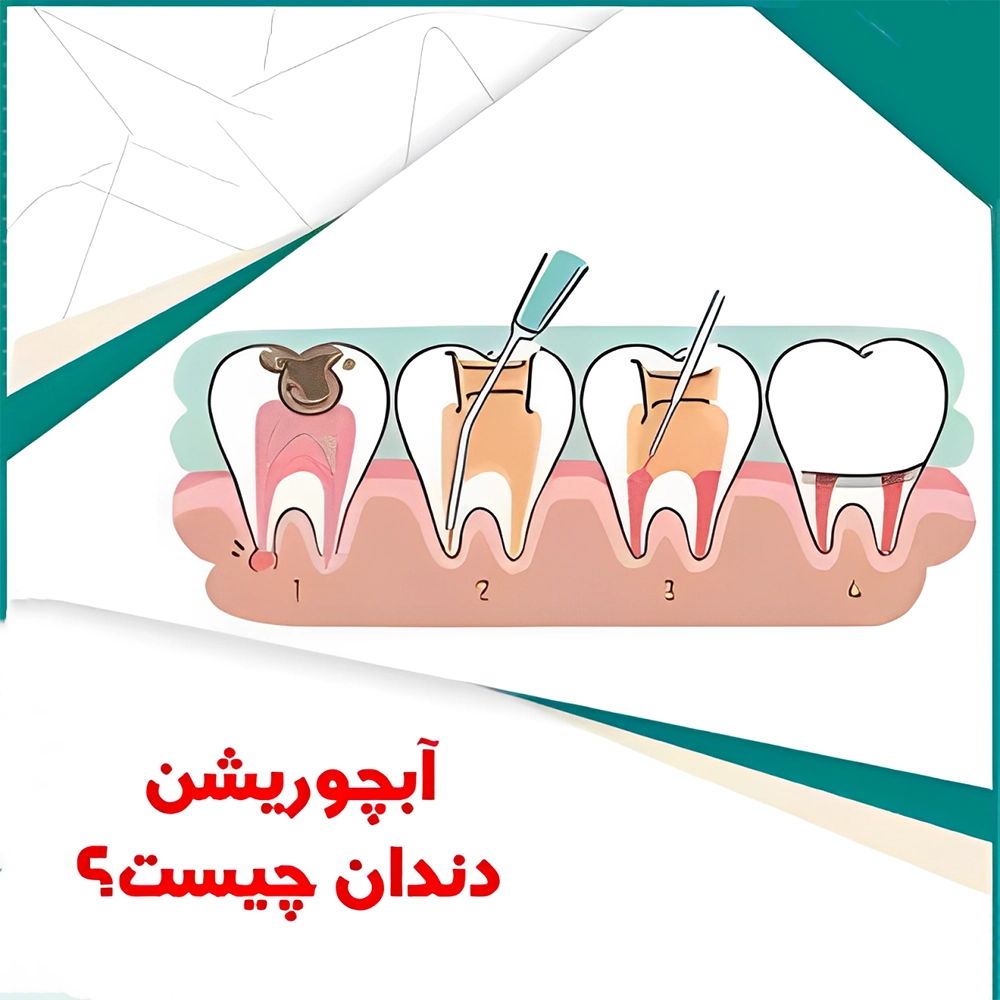 آبچوریشن دندان چیست
