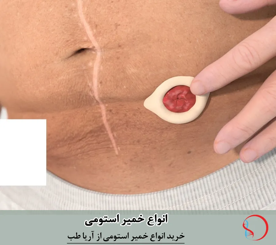 انواع خمیر استومی