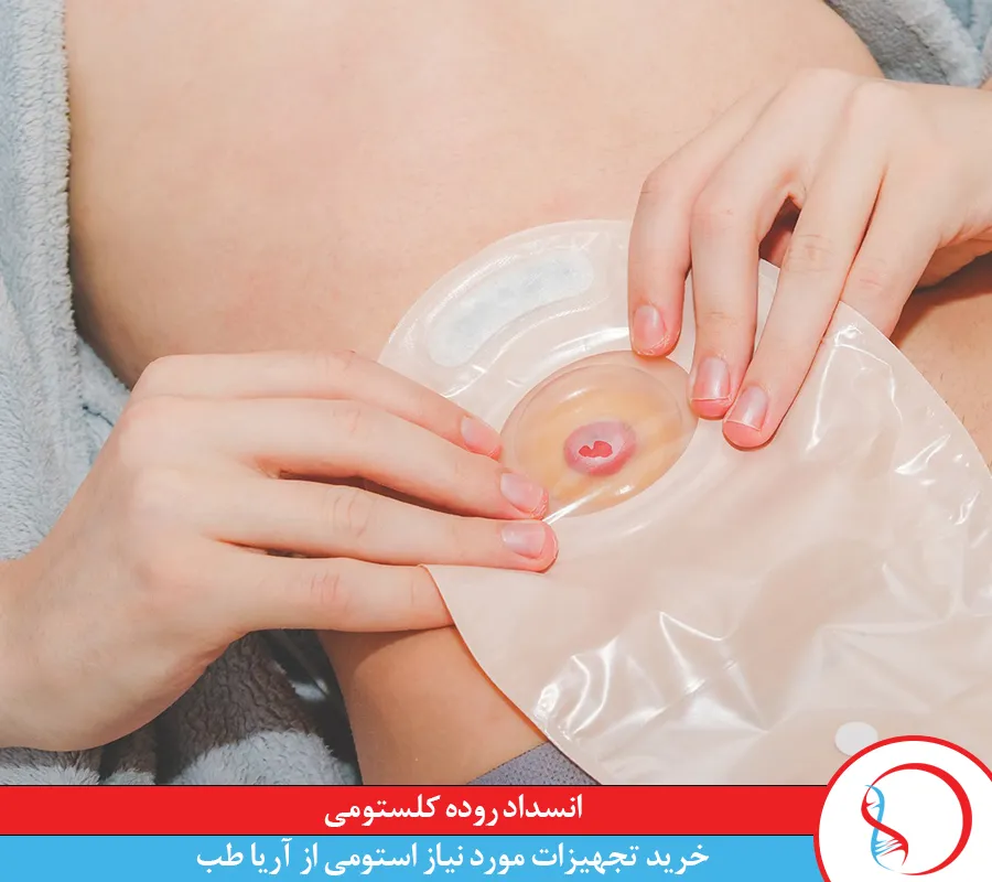 چه چیزی باعث انسداد روده کلستومی می شود؟