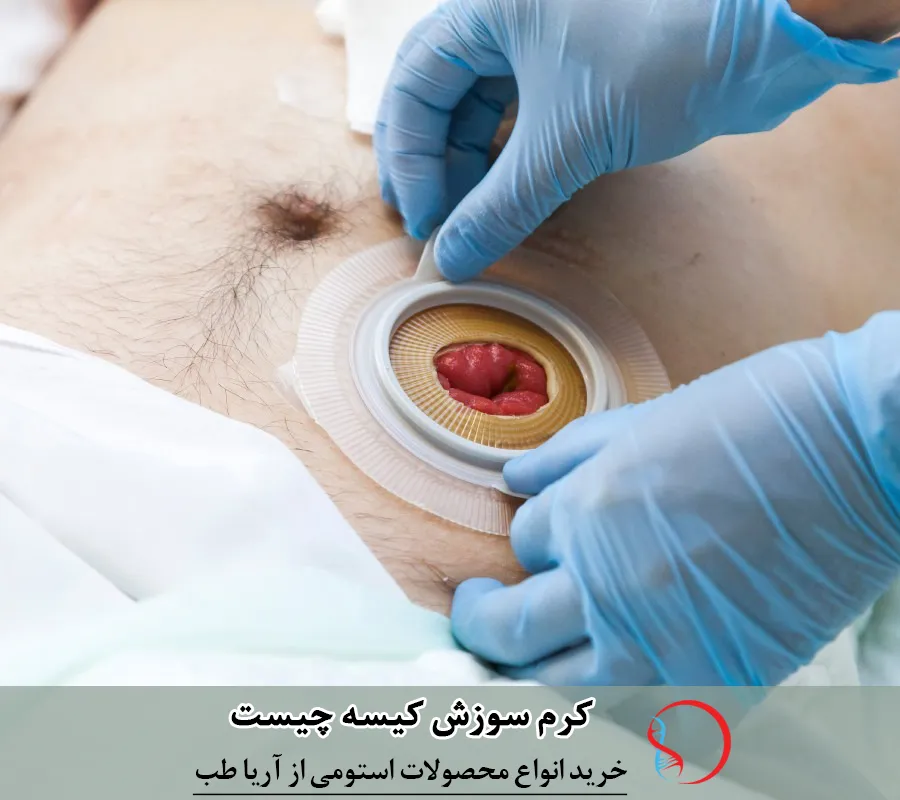 کرم سوزش کیسه چیست